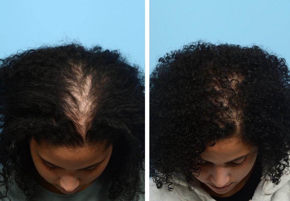 Before and after exosome hair restoration on a Black woman's thinning crown